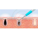 Ultrapeel - Ultrazvučni piling 